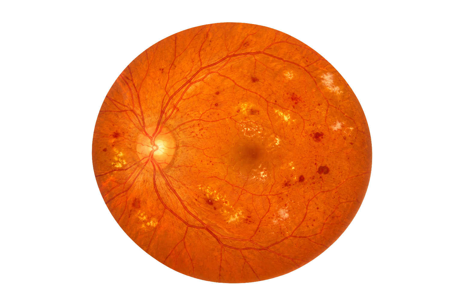Retinografía con signos de retinopatía diabética
